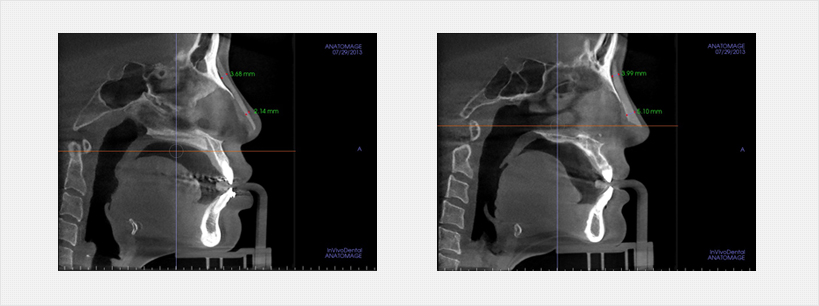 3D CT를 통한 코재수술시 보형물 사이즈 미리 측정 영상
