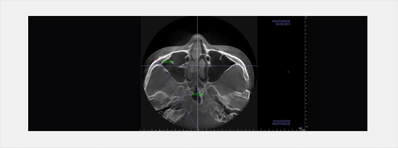 3D CT를 통한 광대뼈성형 예측도 영상